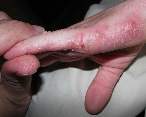 Eczema: Causes, Symptoms, and Treatments - Health News