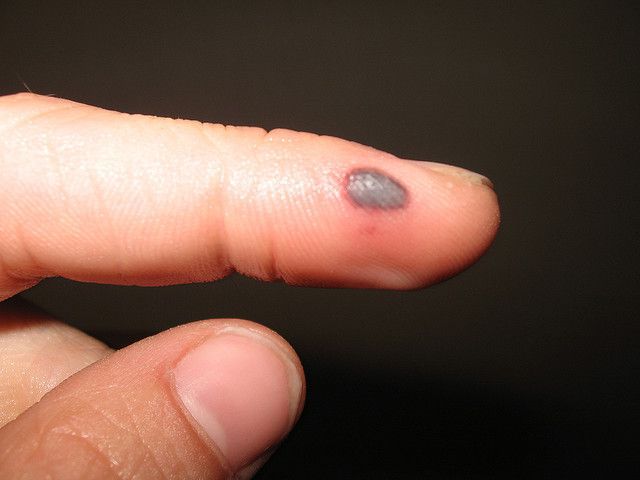 How to Get Rid of Blood Blisters