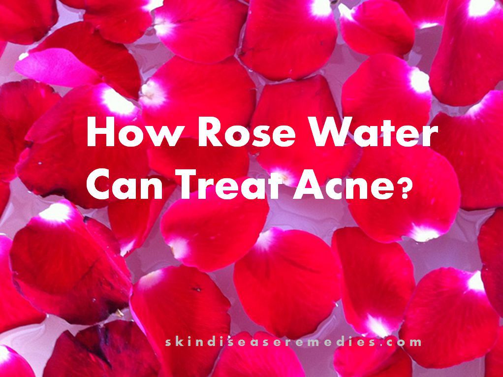 Can Rose Water Treat Acne? Skin Disease Remedies