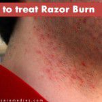 tips to get rid of razor burn