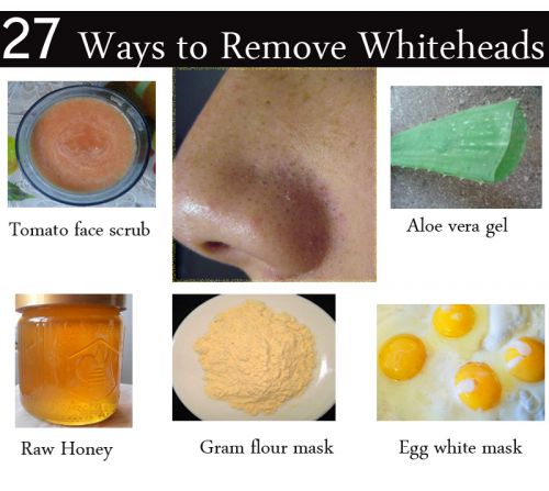 how to get rid of whiteheads on your nose
