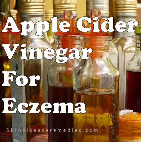 How to Use Apple Cider Vinegar for Eczema - 15 Treatment ...