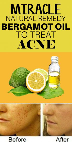 How To Use Bergamot Oil For Acne And Scars 7 Diy Methods