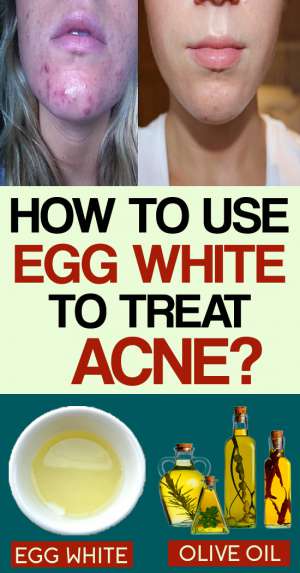 How To Use Egg White For Acne And Acne Scars 13th Methods Skin Disease Remedies